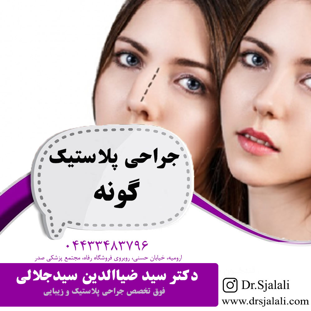 جراحی بینی ثانویه