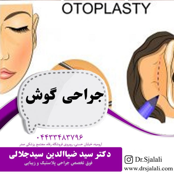 Ear-surgery جراحی گوش در ارومیه | اتوپلاستی در ارومیه
