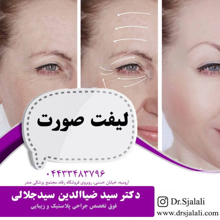 Facelift