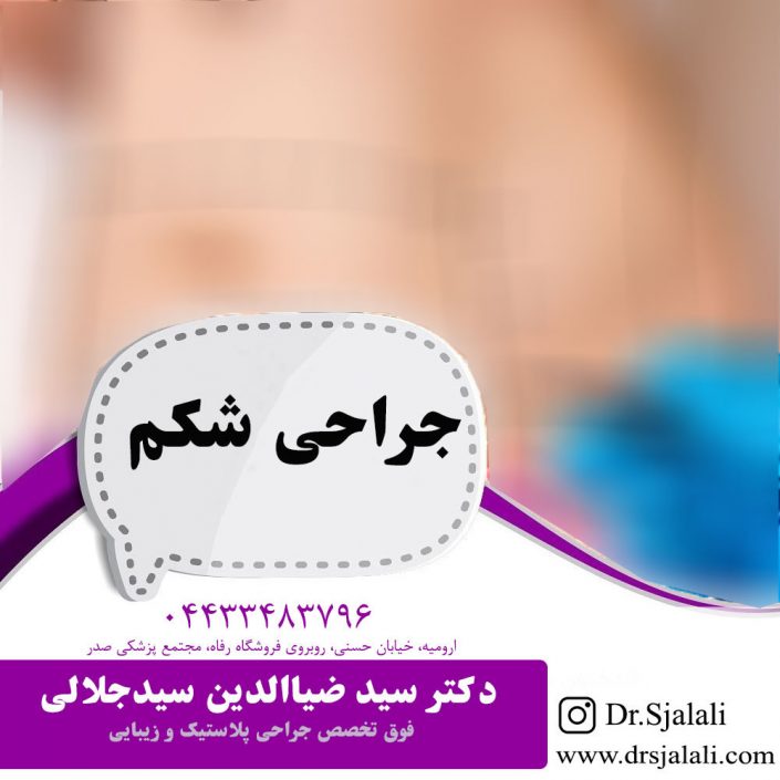 abdominoplasty01