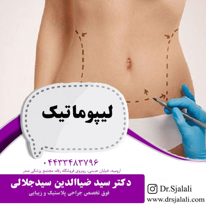 lipomatic لیپوماتیک در ارومیه