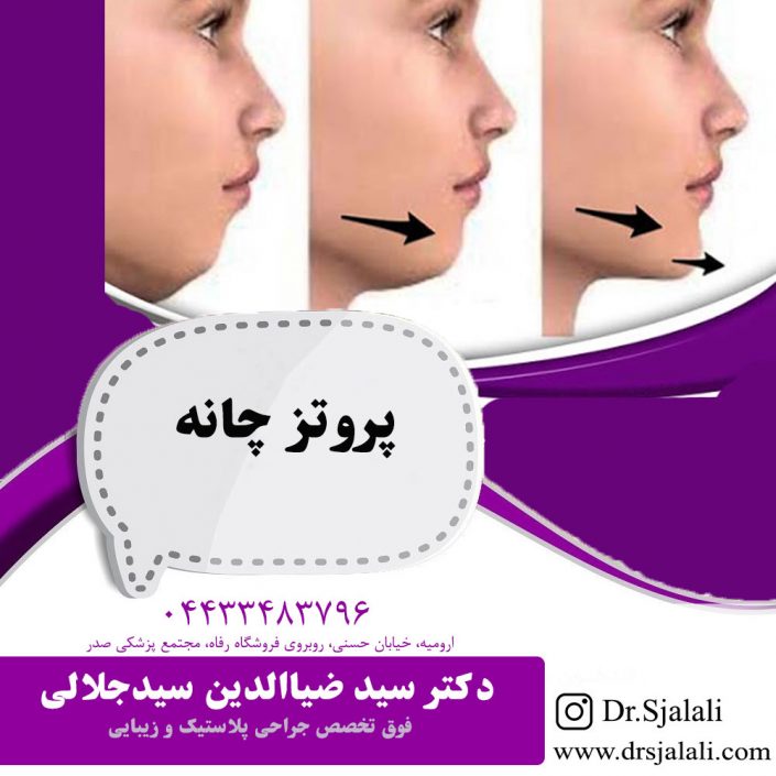 chine-ptotez پروتز چانه در ارومیه