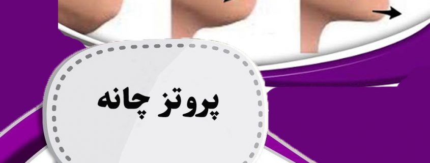 پروتز چانه در ارومیه
