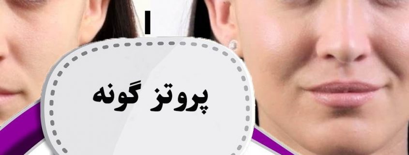 پروتز گونه در ارومیه
