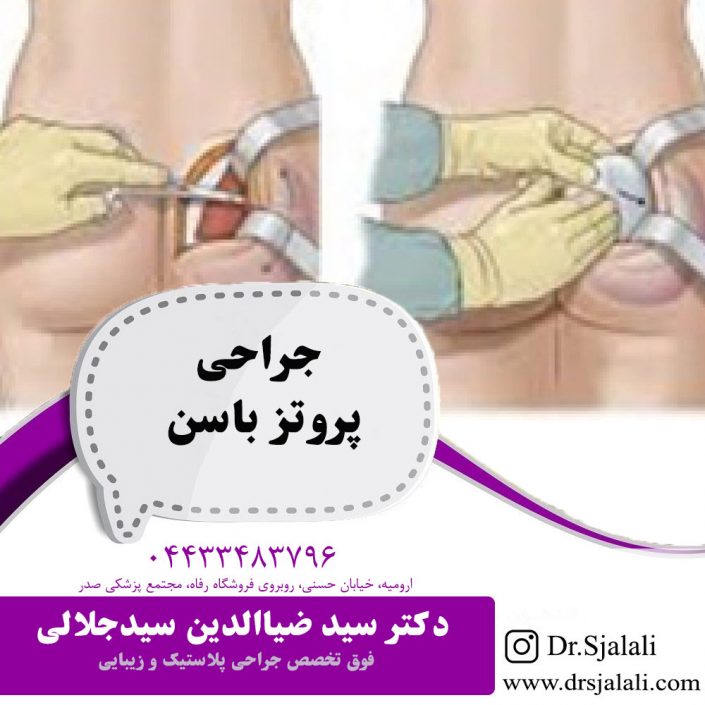 protz-basan جراحی پروتز باسن در ارومیه