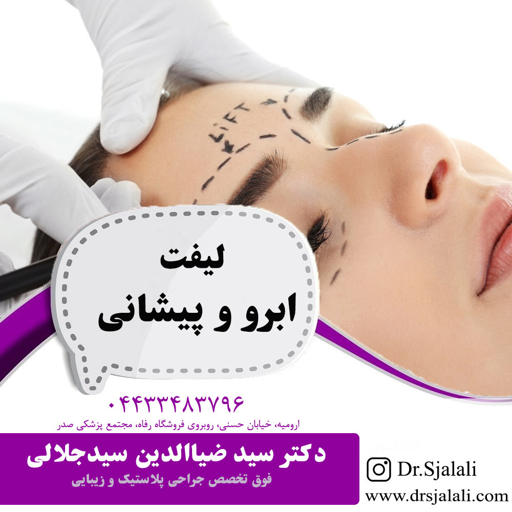 لیفت ابرو وپیشانی در ارومیه