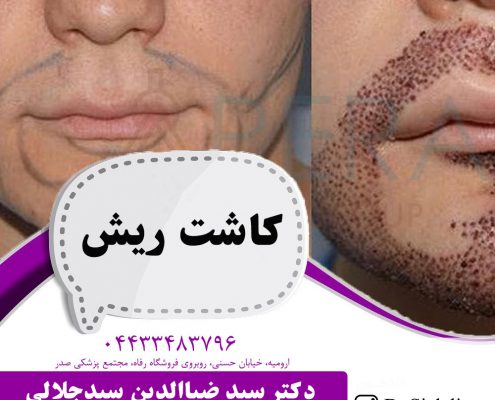 کاشت ریش در ارومیه