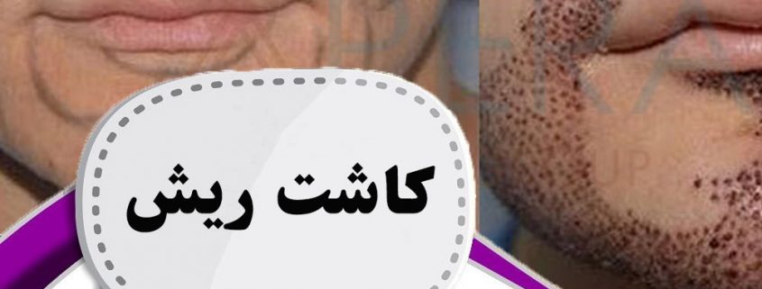 کاشت ریش در ارومیه
